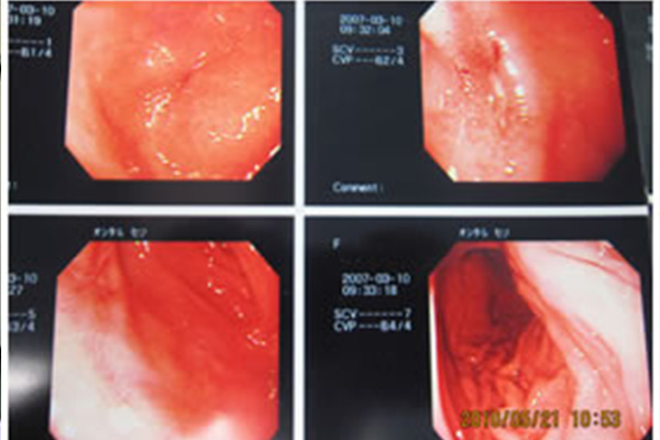 胃カメラ
